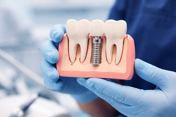 Implantes dentales Palma Mallorca